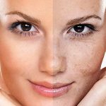 پنج روش مؤثر از بین بردن لک‌های صورت