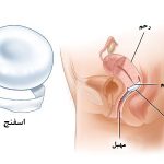 هرآنچه باید در مورد اسفنج ضد بارداری بدانید + آموزش استفاده از اسفنج ضد بارداری